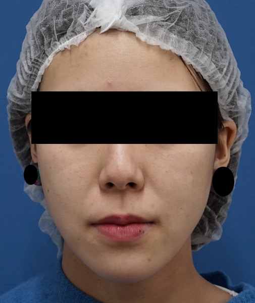 小顔脂肪吸引（ほほ・アゴ下）術前⇒三か月後のAfterの写真