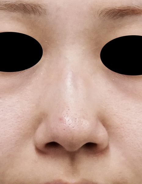 鼻尖縮小、軟骨移植、鼻翼縮小(内側+外側) 1ヶ月後のBefore写真