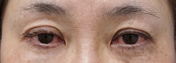切らない眼瞼下垂 術前⇒一週間後のBefore写真