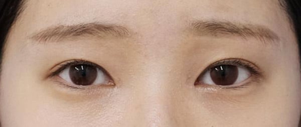 目頭切開（Z形成）、眉下切開　1ヶ月後のAfterの写真