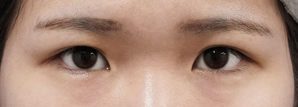 もとびアイゴールド、厚み取り、目頭切開(Z形成) 2ヶ月後のBefore写真