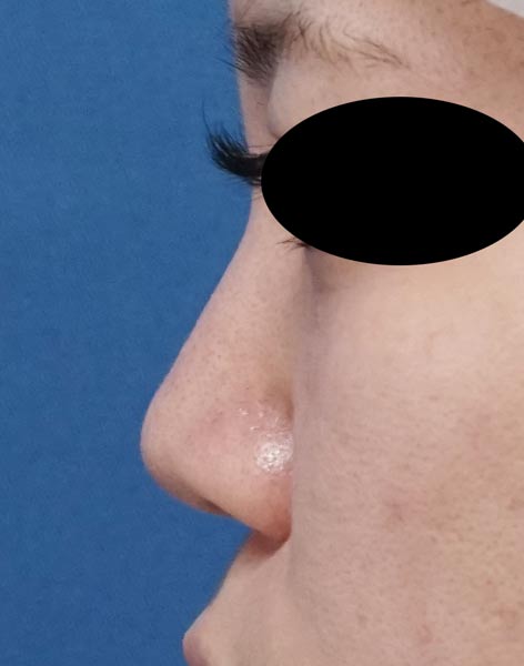 鼻尖縮小（３D法）、鼻尖軟骨移植　1ヶ月後のBefore写真