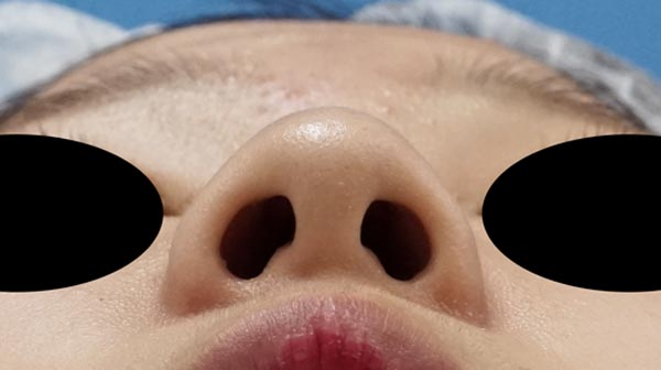 鼻尖縮小（３D法）、軟骨移植、プロテーゼ　1ヶ月後のBefore写真
