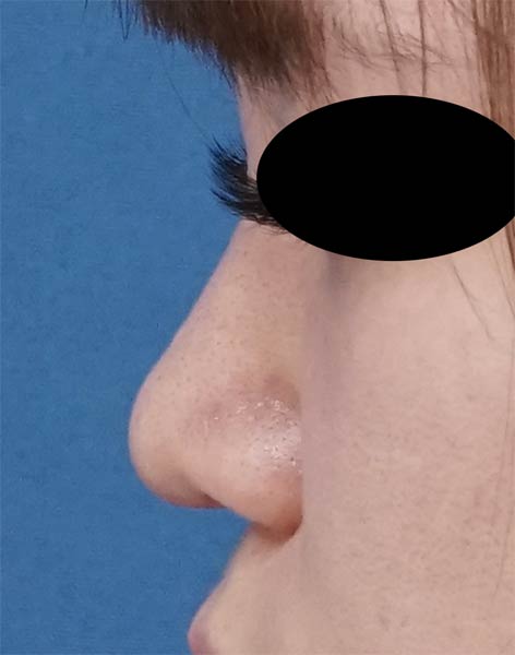 鼻尖縮小（３D法）、鼻尖軟骨移植　1ヶ月後のAfterの写真
