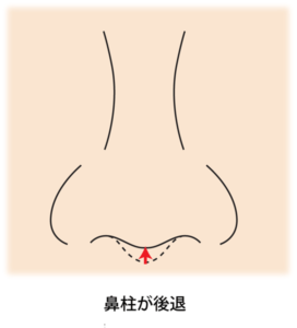 鼻柱が後退している図