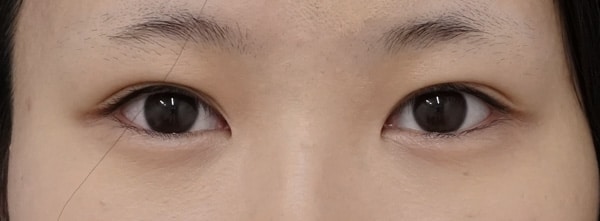 切らない眼瞼下垂プレミアム術前⇒三か月後のAfterの写真