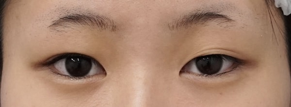 切らない眼瞼下垂プレミアム術前⇒三か月後のBefore写真