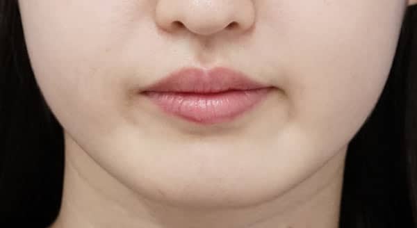 口角を上げるセット（ヒアルロン酸＋ボトックス）　1ヶ月後のBefore写真