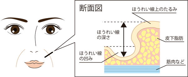 小顔になりたい ホホ アゴ下 ほうれい線上の気になる脂肪を取る方法 東京新宿の美容整形ならもとび美容外科クリニック