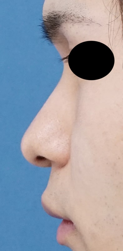 鼻根部クレヴィエルコントア注入　処置前⇒一週間後のBefore写真
