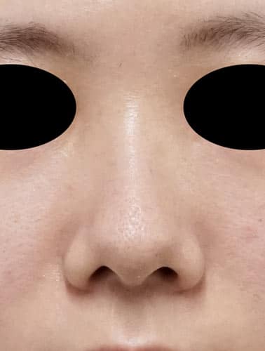 鼻尖縮小、軟骨移植　１ヶ月後のBefore写真