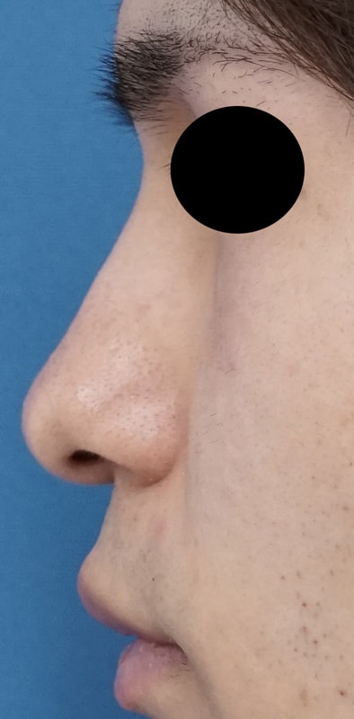 鼻根部クレヴィエルコントア注入　処置前⇒一週間後のAfterの写真