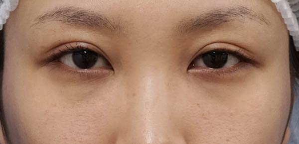 目の下脂肪取り、コンデンス脂肪注入　１ヶ月後のBefore写真