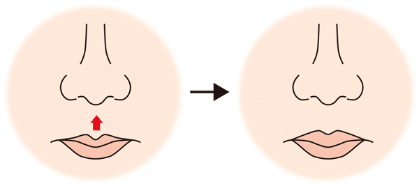 リップリフト変化図