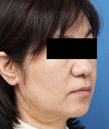 HIFUプレミアム、BNLS(ほうれい線上、ホホ、アゴ下) 3週間後のBefore写真