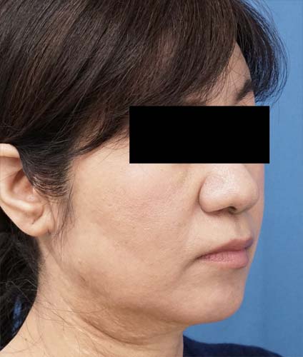 HIFUプレミアム、BNLS(ほうれい線上、ホホ、アゴ下) 3週間後のAfterの写真