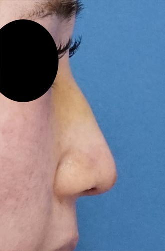 鼻尖縮小（３Ｄ法）、軟骨移植　５日後のAfterの写真