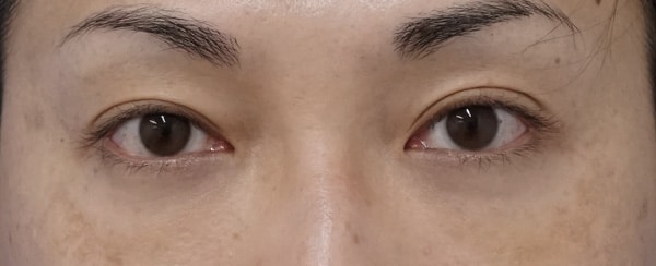目の下の脂肪取り+コンデンス脂肪注入のAfterの写真