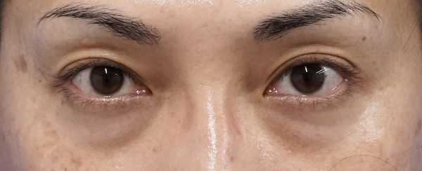 目の下の脂肪取り+コンデンス脂肪注入のBefore写真
