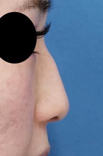 鼻尖縮小（３Ｄ法）、軟骨移植　５日後のBefore写真