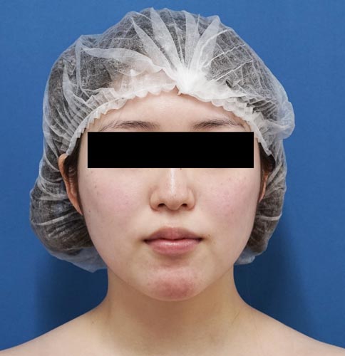 鼻尖縮小＋軟骨移植＋ストラット、鼻翼縮小（内＋外）　３ヶ月後　正面のBefore写真