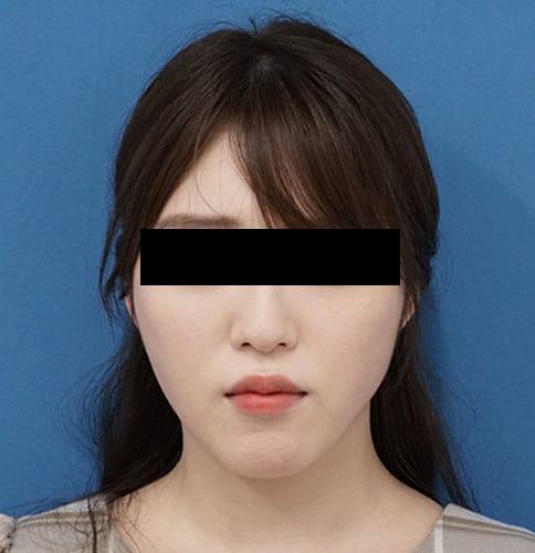 小顔脂肪吸引（ほうれい線上・ホホ・アゴ）　３ヶ月後のAfter写真