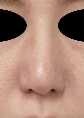 鼻尖縮小（３Ｄ法）　１ヶ月後のAfterの写真