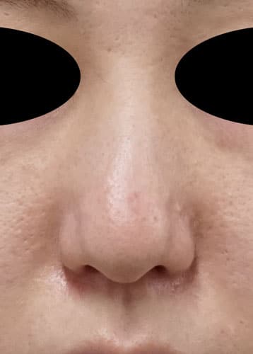 鼻尖縮小（３Ｄ法）　１ヶ月後のBefore写真