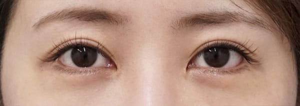 下眼瞼下制（切るタレ目）　１週間後のAfter写真