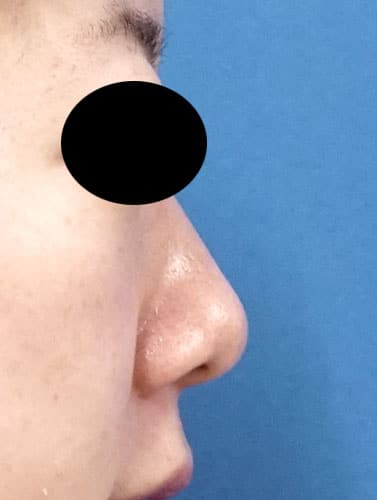 切らない鼻尖延長（MISKO、ミスコ）　２週間後のBefore写真