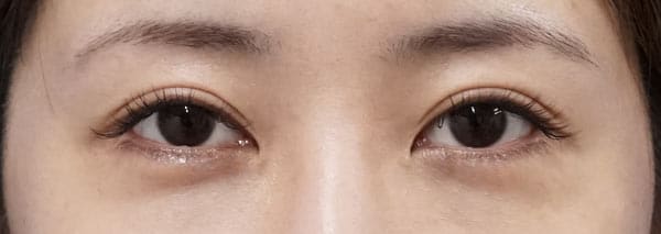 鼻尖縮小＋軟骨移植＋ストラット、鼻翼縮小（内＋外）　３ヶ月後　正面のBefore写真