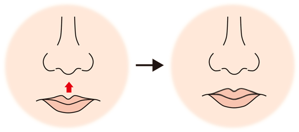 鼻下長短縮（リップリフト）イメージ