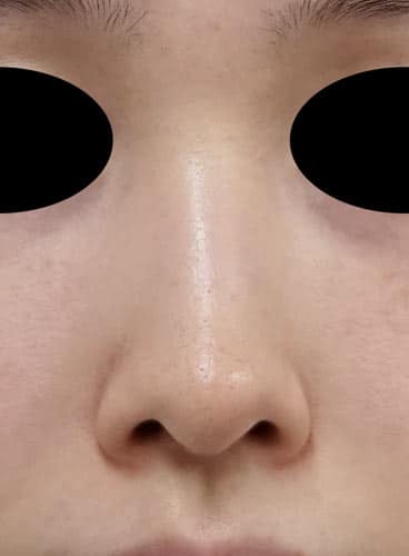 小鼻縮小内側法（フラップ法)　1ヶ月後のBefore写真