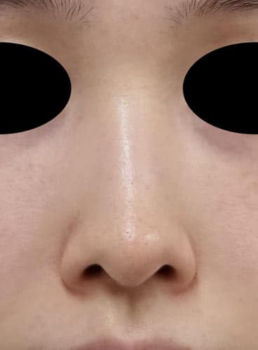 小鼻縮小内側法(フラップ法) 1ヶ月後のBefore写真