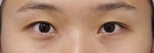 エステティックアイ　手術直後、1週間後、1ヶ月後。閉眼ものBefore写真