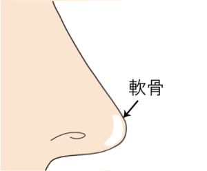 鼻尖軟骨移植