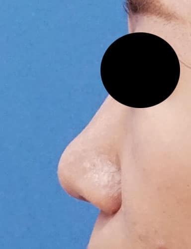 鼻尖縮小（３Ｄ法）＋軟骨移植　１ヶ月後のAfterの写真