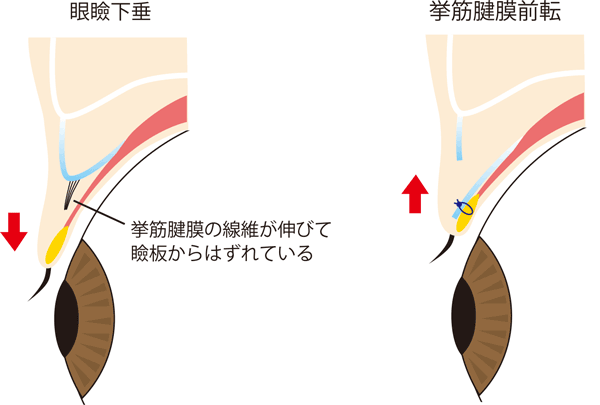 挙筋前転術