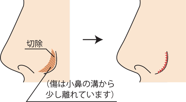 小鼻縮小外側切除方法