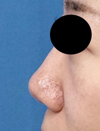 鼻尖縮小（３Ｄ法）＋軟骨移植　１ヶ月後のBefore写真