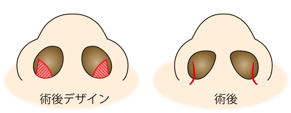 鼻翼縮小（内側法）切開線