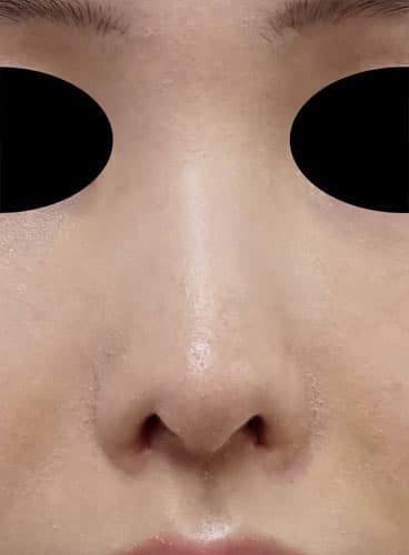 小鼻縮小内側法(フラップ法) 1ヶ月後のAfterの写真