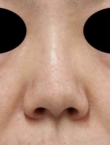 鼻尖縮小＋軟骨移植＋ストラット、鼻翼縮小（内＋外）　３ヶ月後　正面のBefore写真