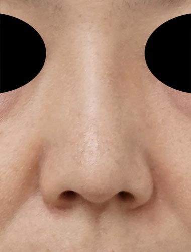 鼻尖縮小、軟骨移植（ストラットも）、プロテーゼ　1ヶ月後のAfter写真