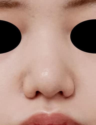 鼻尖縮小（３Ｄ法）、軟骨移植　3ヶ月後のAfterの写真