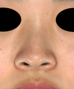 正面手術前鼻翼縮小（内側＋外側）