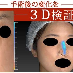 鼻尖縮小、軟骨移植（ストラットも）、プロテーゼ　３ヶ月後　３Ｄ解析