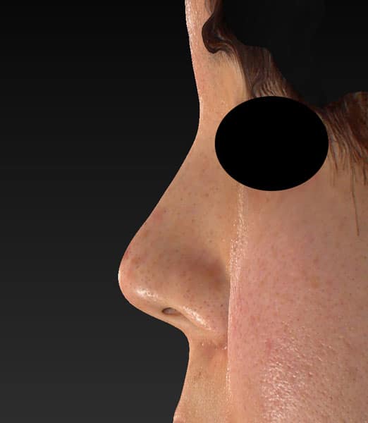 鼻尖縮小（3Ｄ法）、軟骨移植　半年後のBefore写真