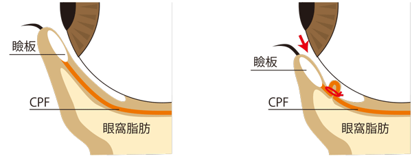 切らないたれ目変化を解説