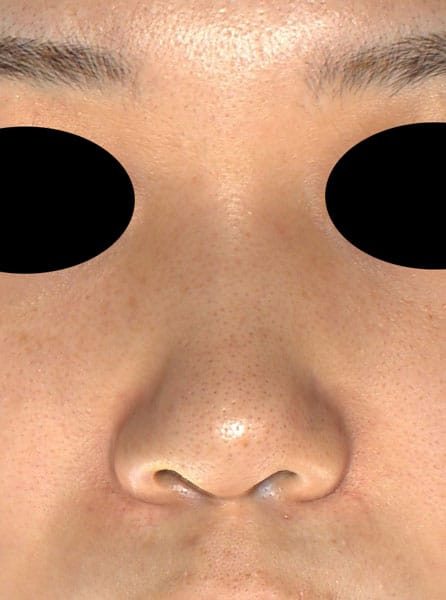 鼻尖縮小、軟骨移植（ストラットも）、プロテーゼ　３ヶ月後　３Ｄ解析のBefore写真
